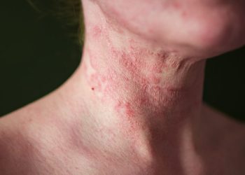 Atopic Dermatitis