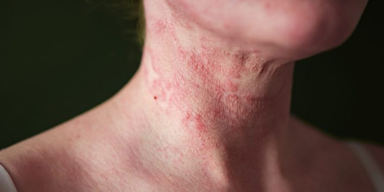 Atopic Dermatitis
