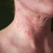 Atopic Dermatitis