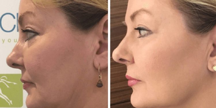HIFU Skin Tightening Facelifts in Demand on Gold Coast