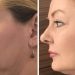 HIFU Skin Tightening Facelifts in Demand on Gold Coast
