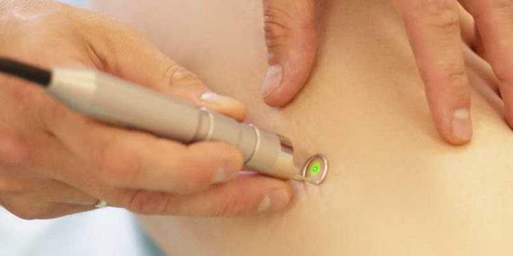 All you need to know before getting treated by radiofrequency ablation!