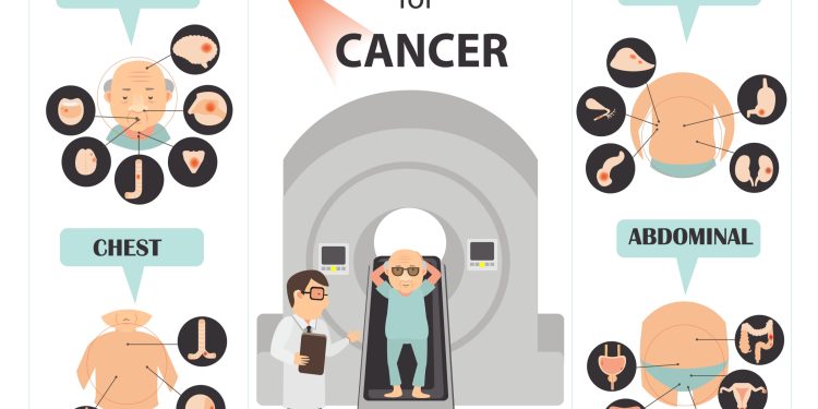 Side effects of radiation therapy