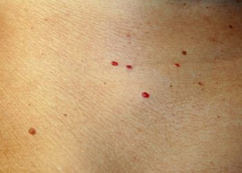 Do you have Red Spots on your Skin? Here’s Why! 