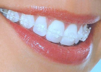 Clear aligner alternative to brace
