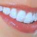Clear aligner alternative to brace