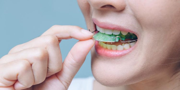 All about Clear Retainers that you should know of