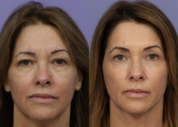Some Exclusive Facts About Laser Skin Resurfacing