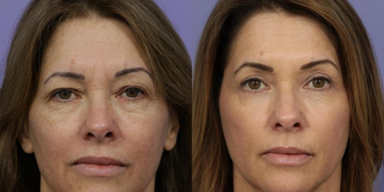 Some Exclusive Facts About Laser Skin Resurfacing