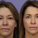 Some Exclusive Facts About Laser Skin Resurfacing