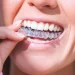 Invisalign in London: Aligning Teeth, Boosting Confidence